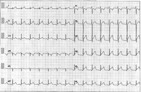 20130529_ECG_june