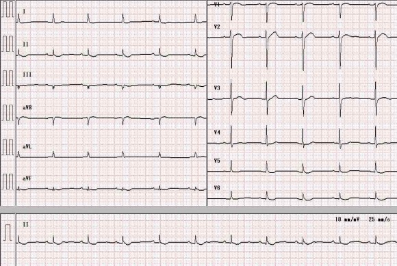 ECG-1