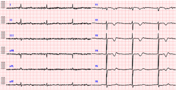 ECG1302