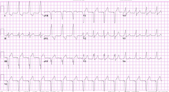 EKG