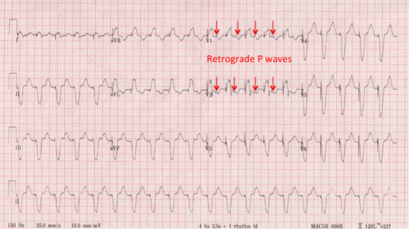 EKG-with-arrows