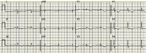 EKG