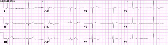 EKG2-1024x273