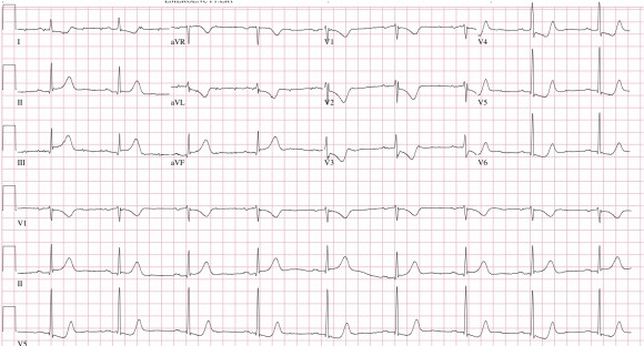 EKG_KH