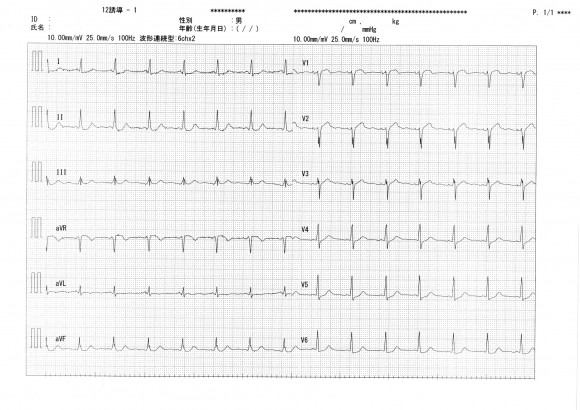 Ischemic-ECG-1-1