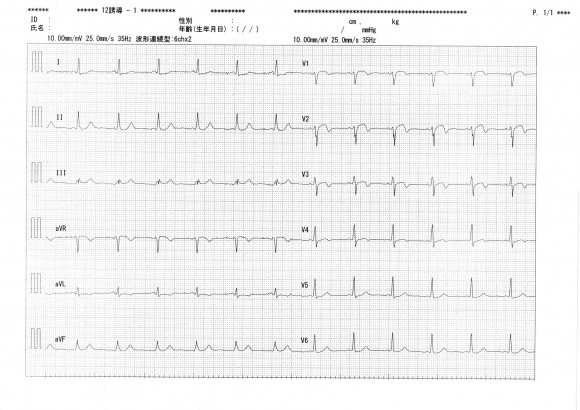 Ischemic-ECG-1-2