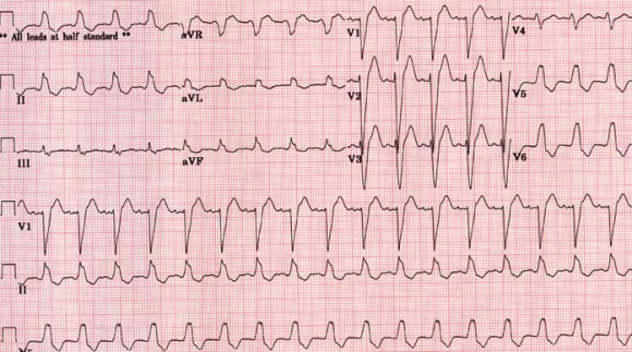 LBBB1