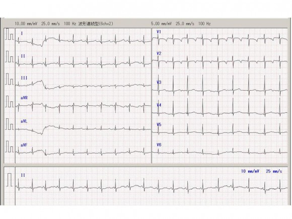 ecg