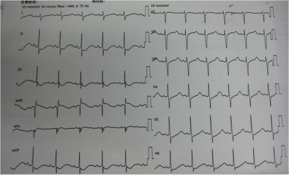 ecg1307