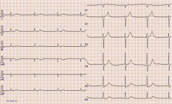 ekg