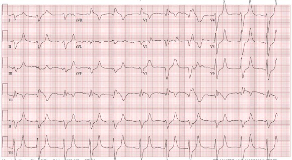 hyperK-ekg-pre-tx