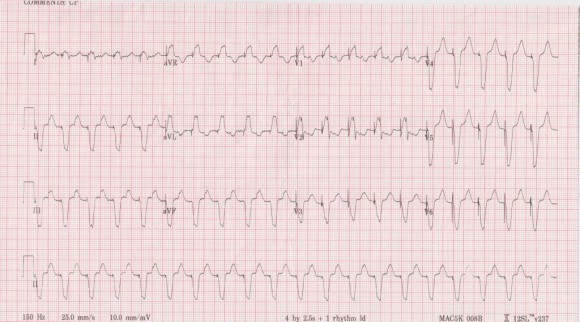 pacemaker-mediated-tachy1-e1384620042709