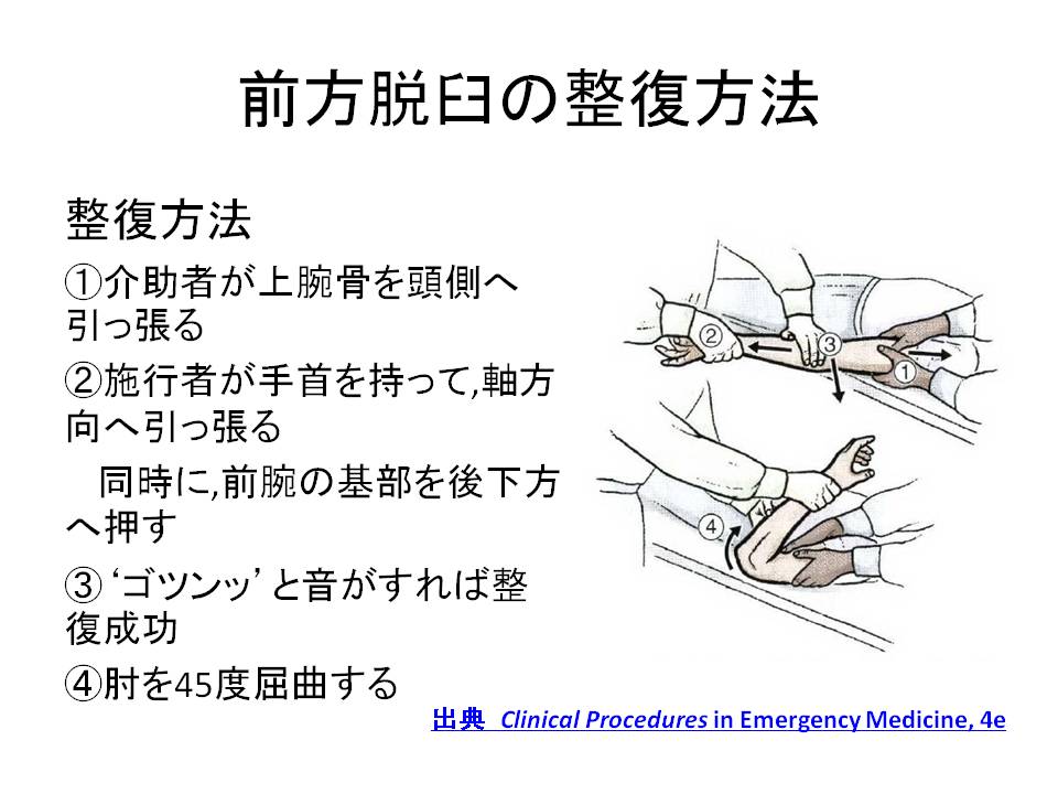 非 還 納 性 ヘルニア 徒手 整復 法 と は